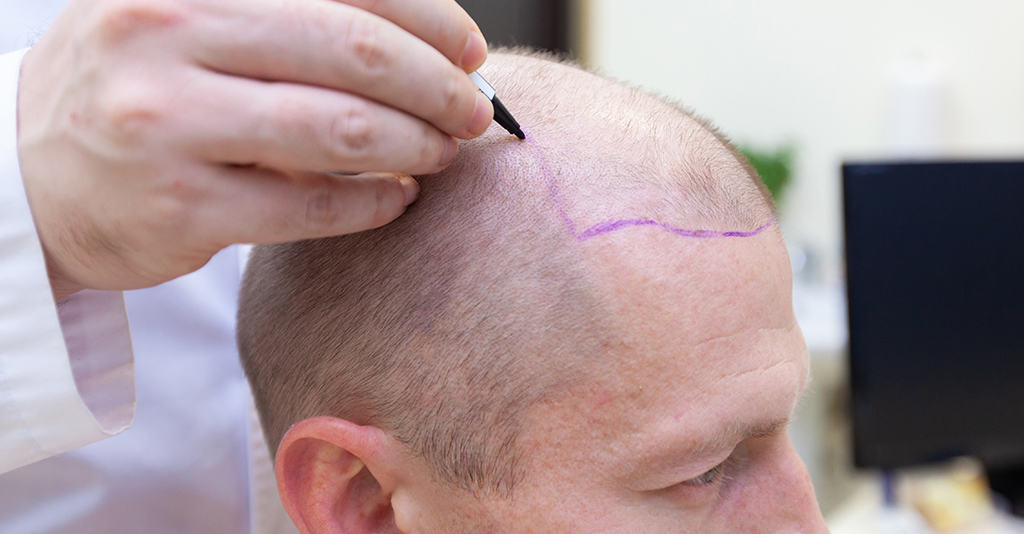 H&aring;rtransplantation