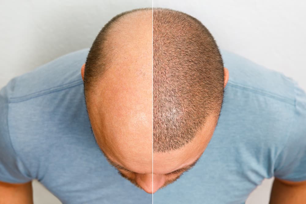 Hårtransplantation mod hårtab Hårtransplantation mod hårtab