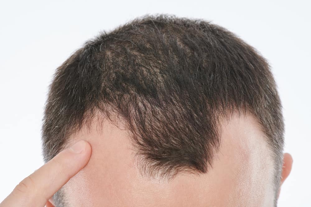 mandligt-arveligt-haartab Arveligt hårtab (androgen alopeci)