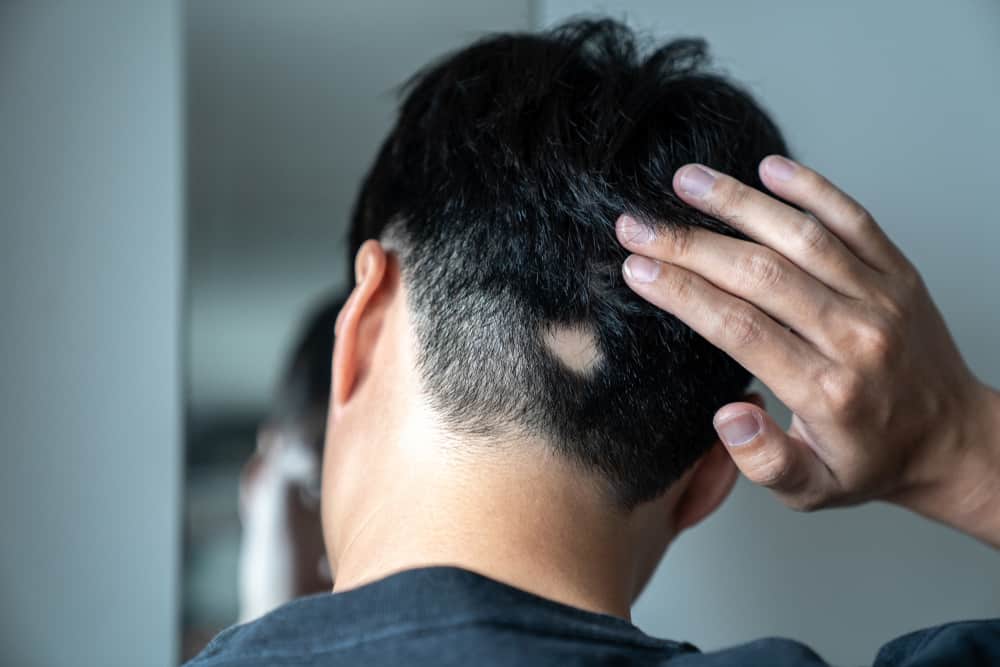 Pletskaldethed (alopecia areata) Pletskaldethed (alopecia areata)