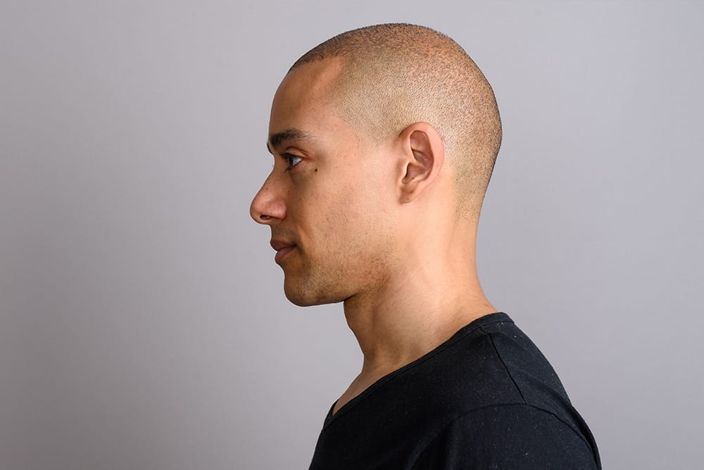 Scalp Micro Pigmentation mod hårtab Scalp Micro Pigmentation mod hårtab